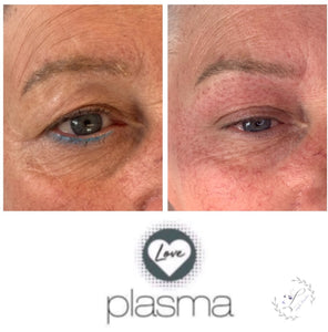 Love Plasma training - Essex (£3600 incl kit)