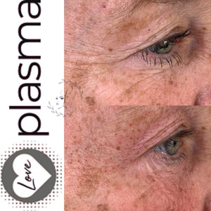 Love Plasma training - Essex (£3600 incl kit)
